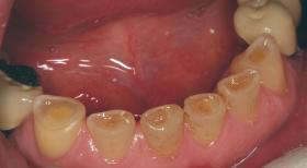 porcelain veneer